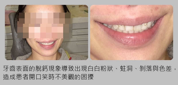 矯正後齒面脫鈣留痕跡 美齒貼片輕鬆微整改善