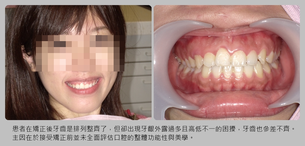 矯正後牙齦外露又不齊 靠上唇定位術+美齒貼片挽救