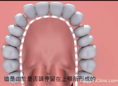 口呼吸如何影響臉型和牙齒
