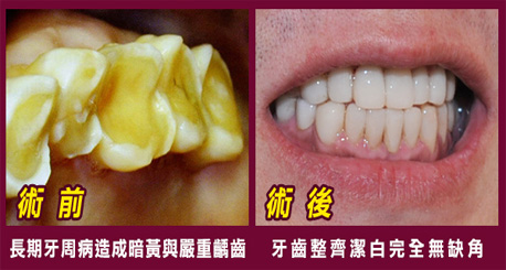 口腔健康要全面性 全口治療牙齒問題遠離你！