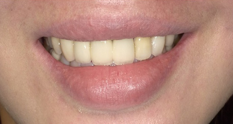 矯正後牙齦反變明顯 靠上唇定位術補救