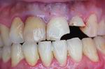 前牙斷裂，牙齒也有發黃發黑蛀牙