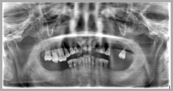 牙周病好不了又引發牙痛 原來是缺牙不補惹禍
